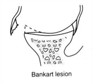 Bankart lesion
