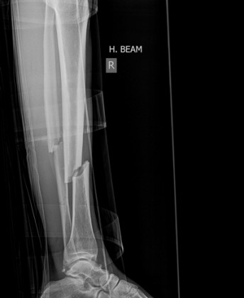 X-ray showing a fractured lower leg.